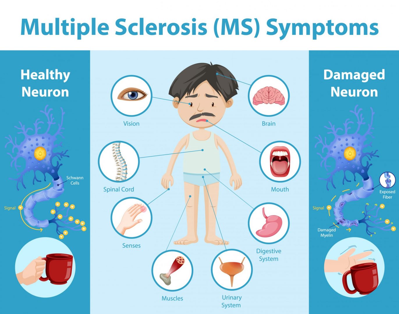 What is Multiple Sclerosis (MS)? - Willingness